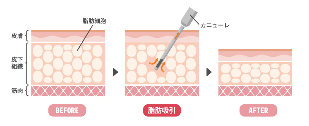 そもそもどんな施術？