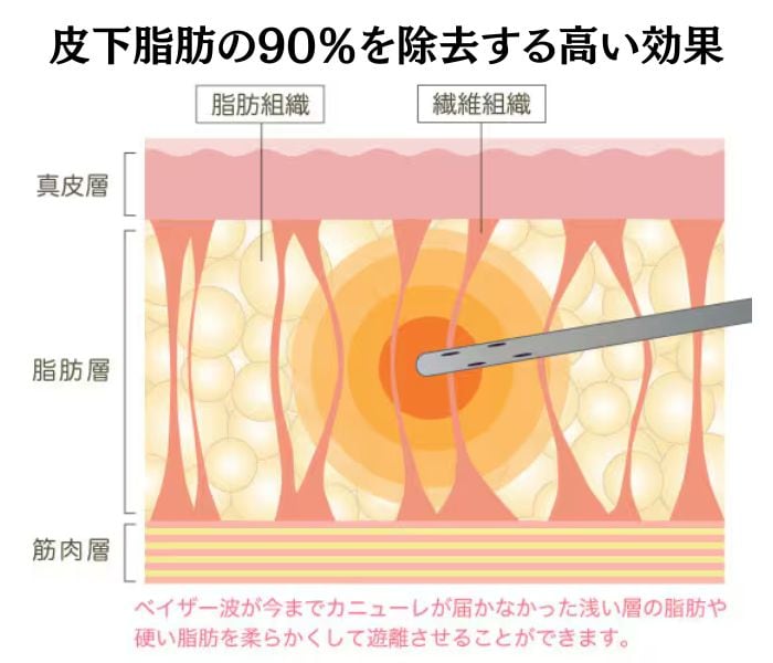 根こそぎとれるVASER(ベイザー)脂肪吸引って？