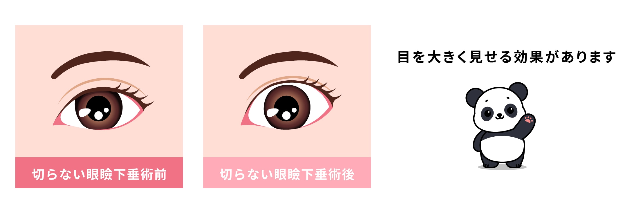 切らない眼瞼下垂術との併用でさらに効果的に👁️