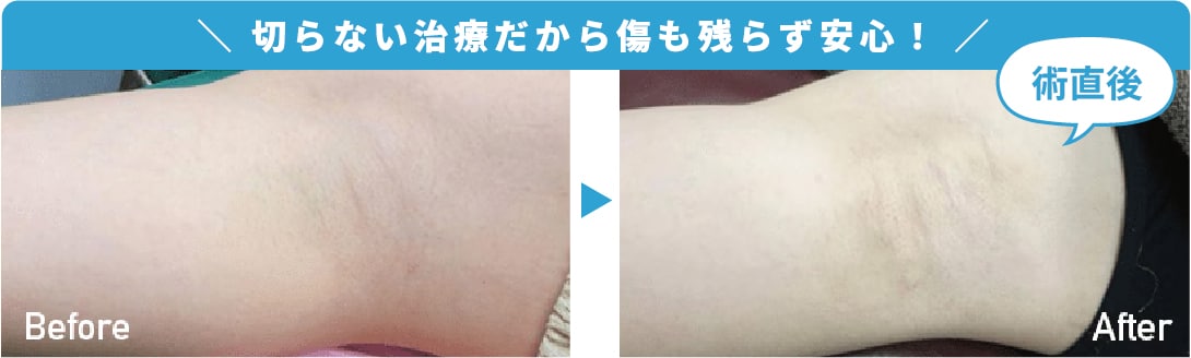 【徹底対策】ミラドライのダウンタイムを最小限にするために。脇汗治療が得意な西田医師のミラドライなら低ダウンタイム＆安全✨