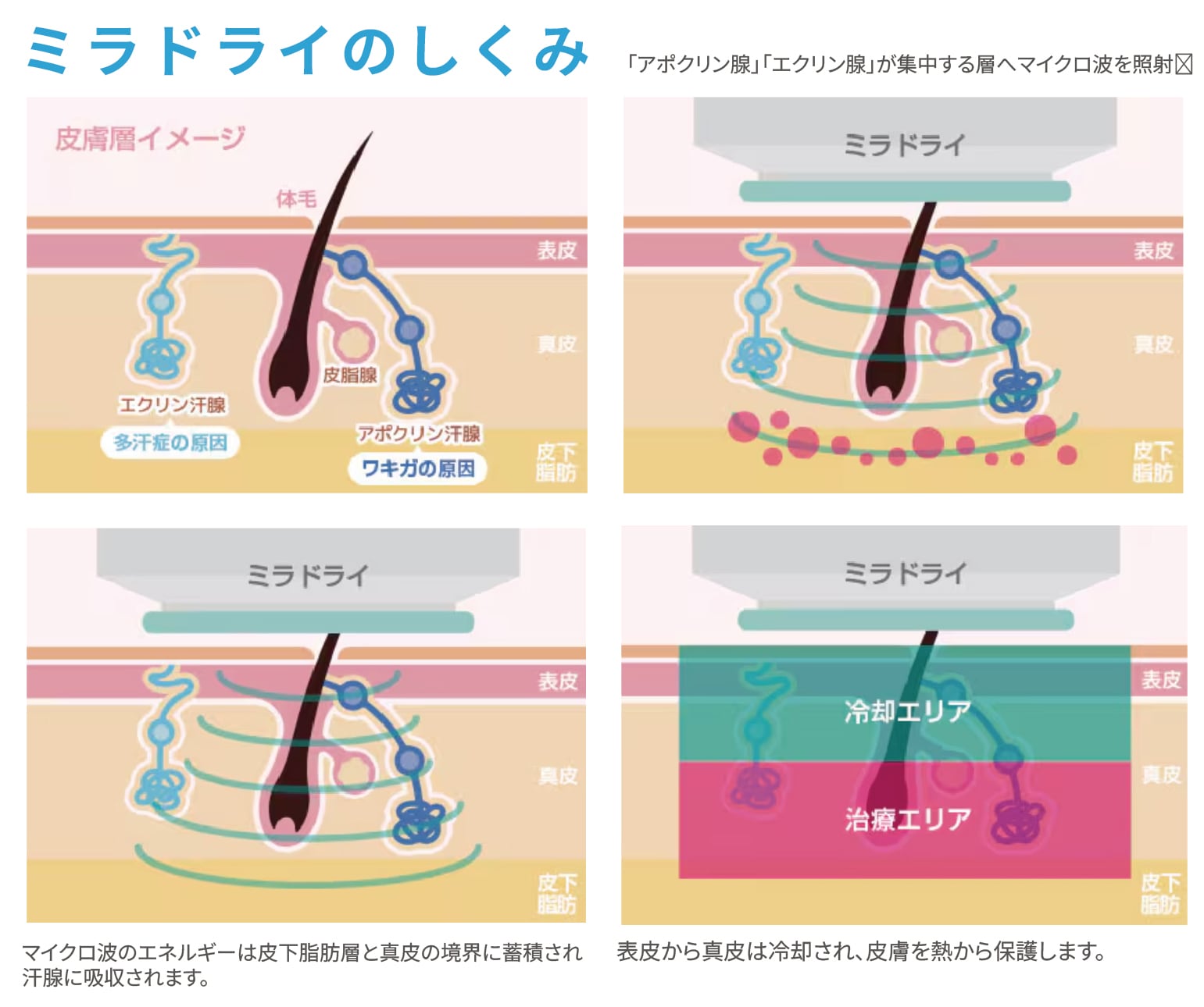 ミラドライの仕組みとは？1日で帰れる脇汗治療！西田医師の脇汗治療なら安心安全＆効果を実感🔰