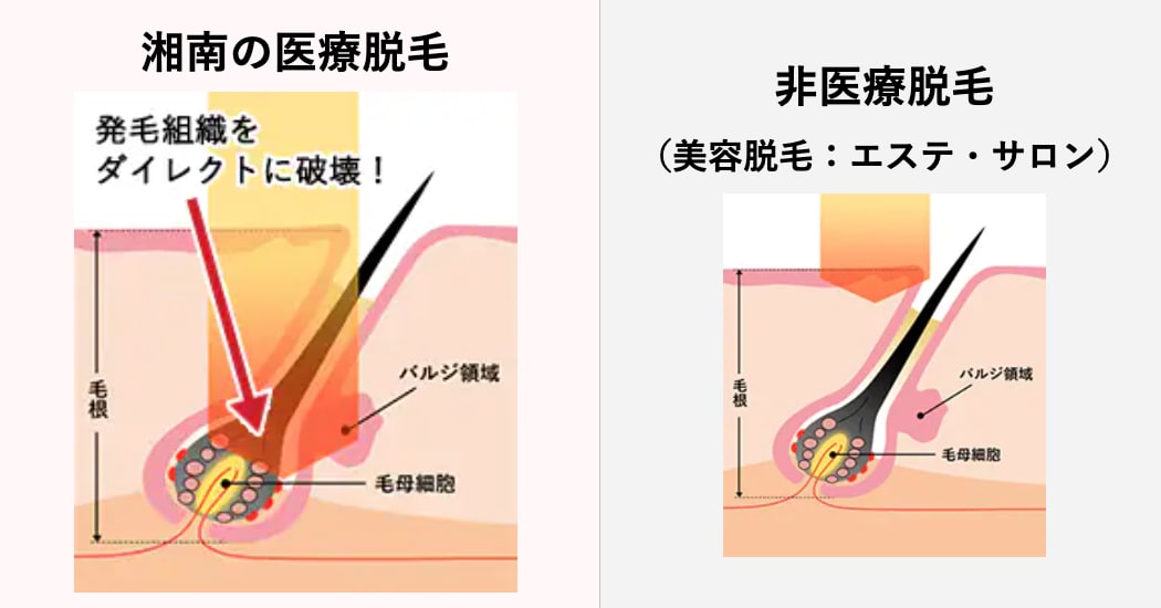 エステとの比較