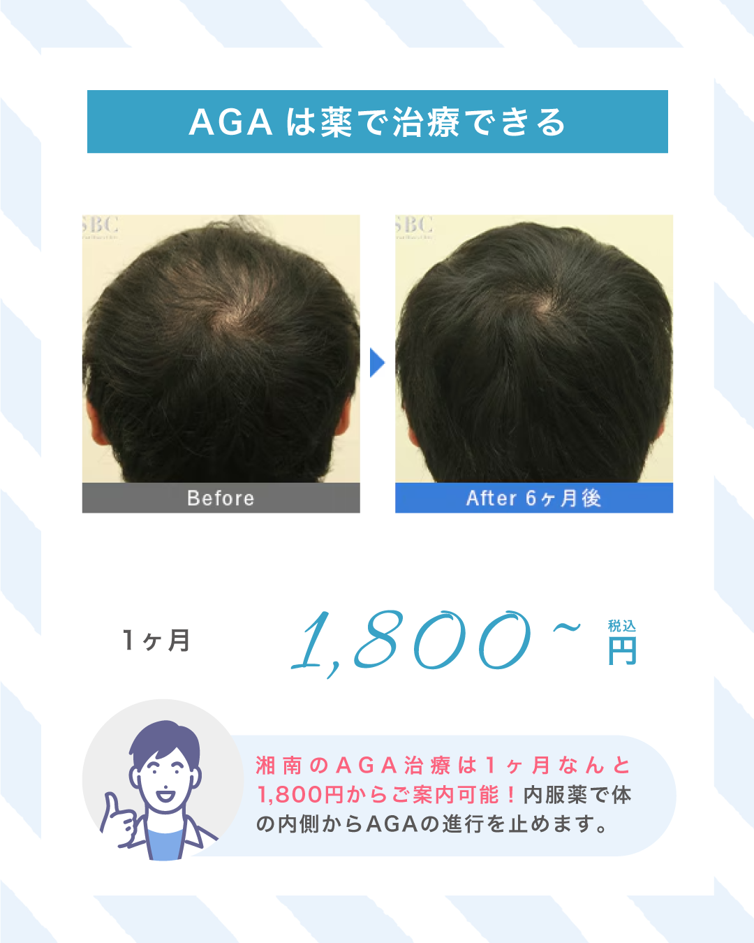 AGAは薬で治療できる