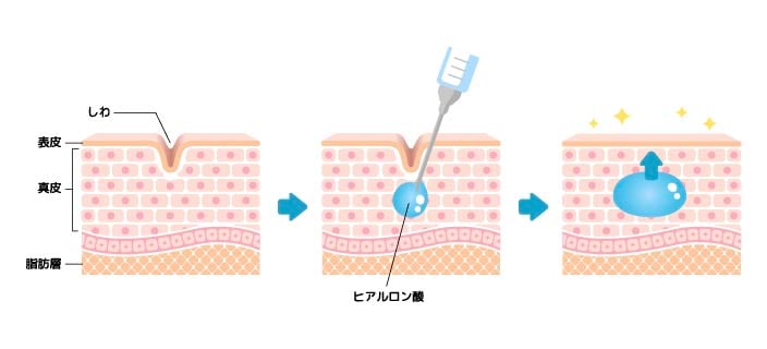 安全性の高いヒアルロン酸