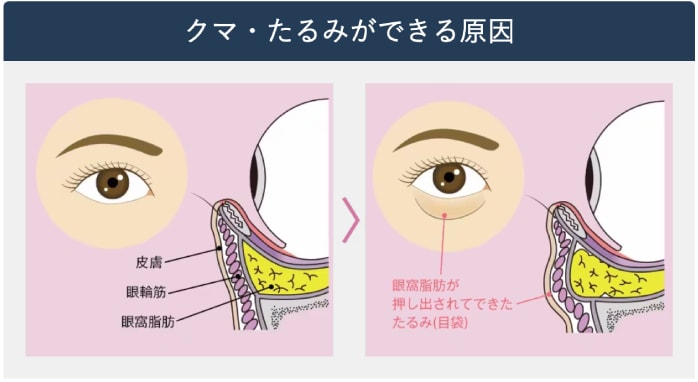 見た目を老けさせる原因は目の下の眼窩脂肪