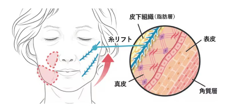 糸リフト