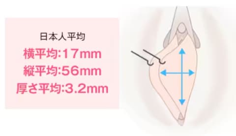 ■VIOの脱毛をしたらなんだかビラビラ(小陰唇)が大きい気がした！■