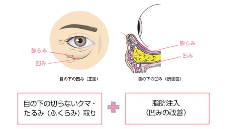 なぜ脂肪を取るのに、脂肪注入が必要なの？