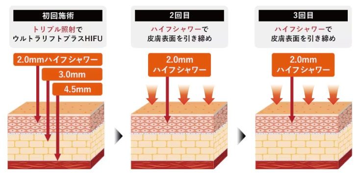 HIFUプレミアムセットの施術イメージ