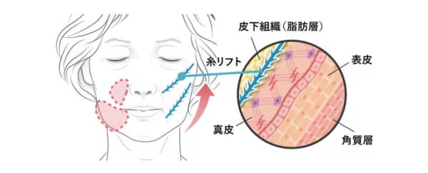 糸リフトの効果（その１）