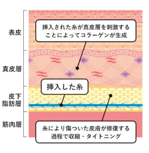 糸リフトの効果（その２）