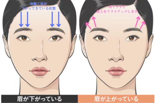 切らない眉上リフトとは？