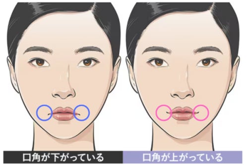 切らない口角挙上とは？