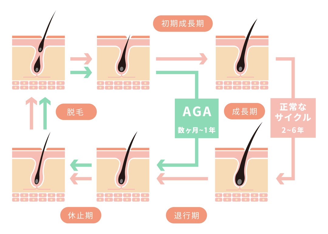 正常なヘアサイクルとAGAのヘアサイクル