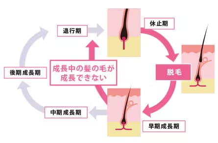 【薄毛のヘアサイクル】