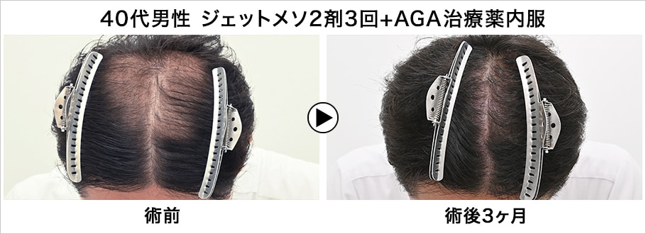 【ミノキシジルと成長因子を高圧エアー注入】痛みなし！ダウンタイムなし！のメソセラピー「ジェットメソ」【薄毛治療なら湘南aga新宿本院】｜湘南agaクリニックの薄毛治療・自毛植毛 7110