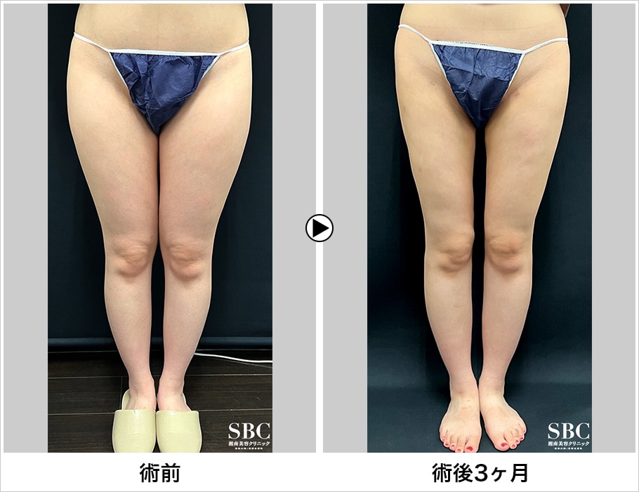 太もも、臀部、膝脂肪吸引 圧迫着 S 圧迫 湘南美容外科 - レッグウェア