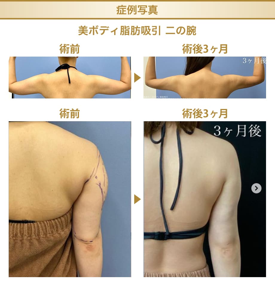 アミュレット 脂肪吸引 二の腕 ボレロ 湘南美容外科 - 通販 - www