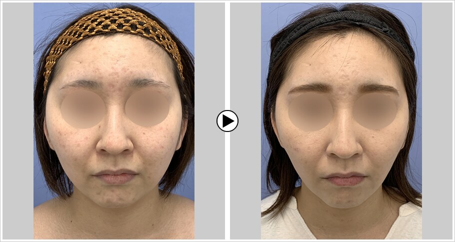 小顔治療症例数全国トップクラス フェイスラインモニター募集 美容整形 美容外科の湘南美容クリニック