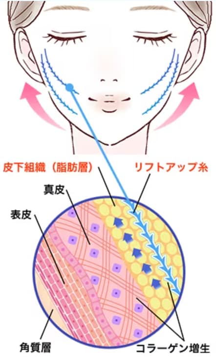 糸リフトの解説