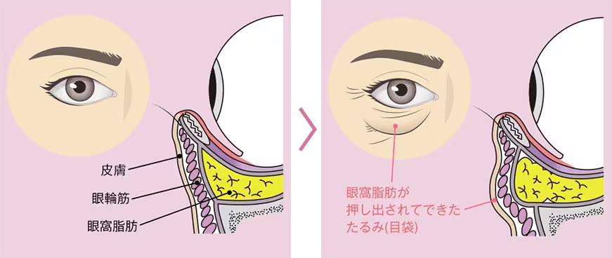 加齢による目の下の変化